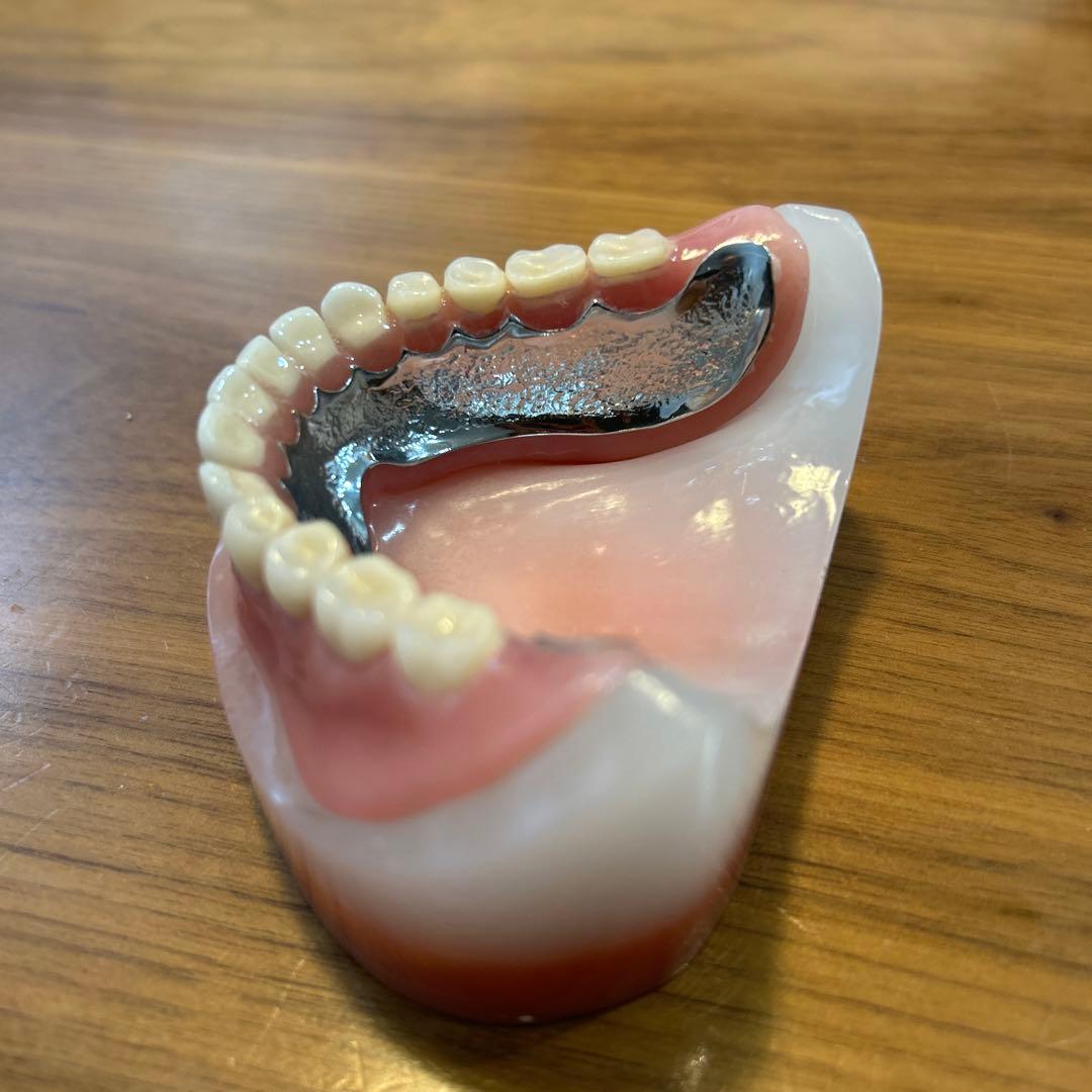 歯科サンプル　金属床義歯　模型付き　歯科医院